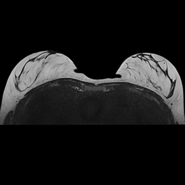 MRI Breast